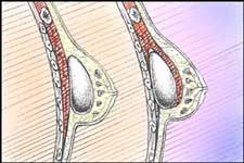 l'impianto è posizionato in una ''tasca'' che viene creata direttamente sotto il tessuto mammario o al di sotto del muscolo toracico.